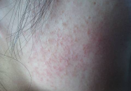 私密与大腿缝长了痘,揭秘大腿缝长痘的成因与护理方法